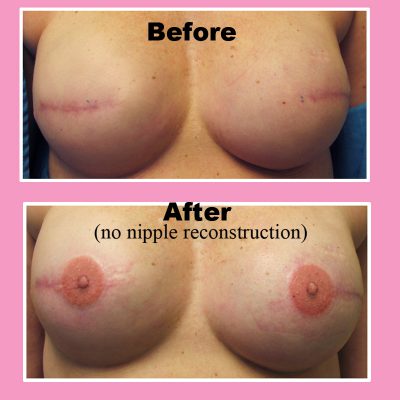Para dhe pas operacionit të thimthave. Foto: community.breastcancer.org